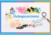 Día Mundial del Colangiocarcinoma: 19 de febrero colangiocarcinoma