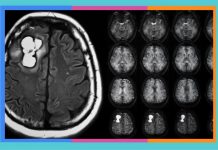 Día Internacional de los Tumores Cerebrales: 8 de junio tumores-cerebrales
